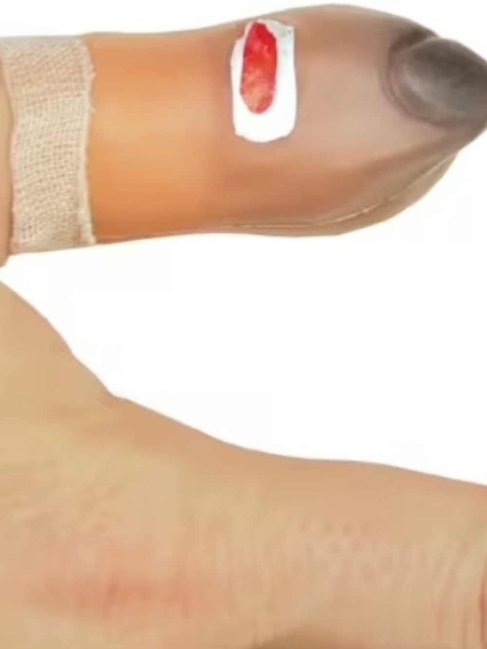 Bruised Thumb
